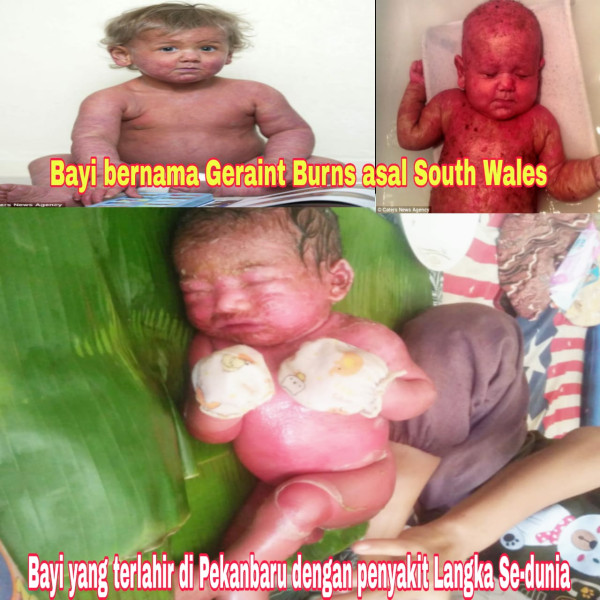 Bayi Lahir Kondisi Kulit Mengering dan Memerah di Desa Baru Dirujuk ke RS Umum Bangkinang Bayi Lahir Kondisi Kulit Mengering dan Memerah di Desa Baru Dirujuk ke RS Umum Bangkinangi