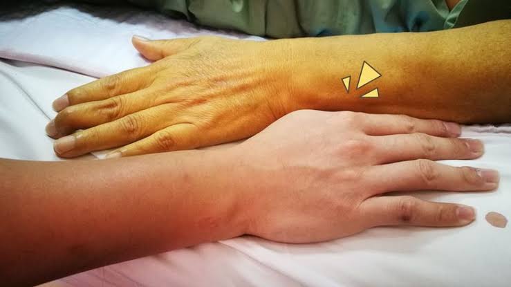 Waspada Mata dan Kulit Menguning Akibat Hepatitis Akut Waspada Mata dan Kulit Menguning Akibat Hepatitis Akuti